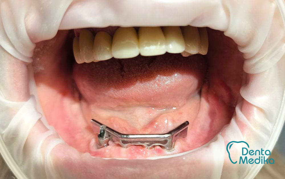 Třmenová hybridní náhrada na implantátech pro bezzubou čelist 5